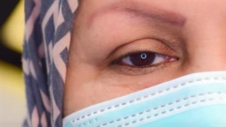 کاشت ابرو در کرج | کاشت ابرو با نتایج خیره‌کننده