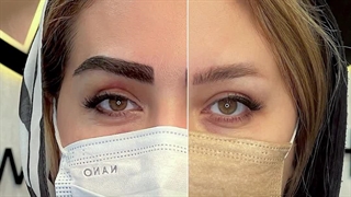 کاشت ابرو در کرج | ابروهای پرپشت، راز جذابیت شما