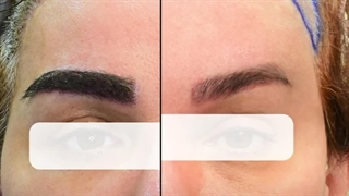 کاشت ابرو در کرج | کاشت ابرو، کلیدی برای جذابیت
