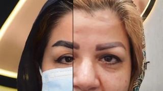 کاشت ابرو در کرج | کاشت ابرو، گامی به سوی زیبایی