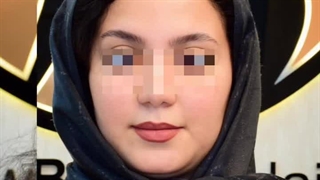 کاشت ابرو در کرج | ابروهای خوش‌فرم، امضای جذابیت شما