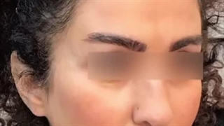 کاشت ابرو در کرج | کاشت ابرو، کلید زیبایی چهره