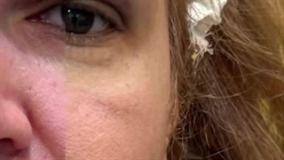 کاشت ابرو در کرج | ابروهای پرپشت، امضای زیبایی چهره