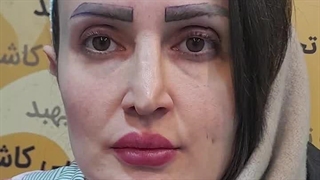 کاشت ابرو در کرج | ابروهای خوش‌فرم، اعتمادبه‌نفس بی‌کران