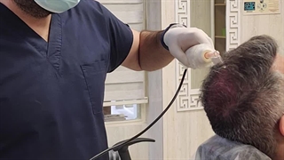 اوزون تراپی مو در کلینیک آوینا