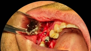 ایمپلنت دوم آقای عباسی توسط دکتر حمید پورصادقی