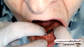 دکتر سید علی ضیائی کاشت ریش