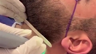 لیزر ریش اقایان