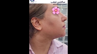 نمونه‌ای از رفع غبغب (3)