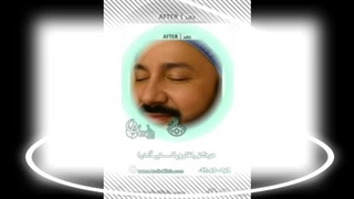 تاثیر بلفاروپلاستی بر بینایی افراد