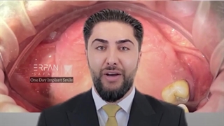 زراعة الأسنان الرقمیة لیوم واحد فی شیراز | الدکتور عرفان صفری