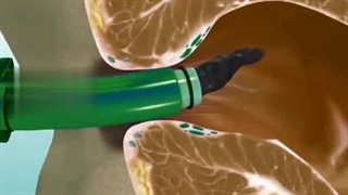 درمان بواسیر با رابربند - کلینیک پایتخت