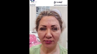 انجام لیفت صورت با نخ (5)