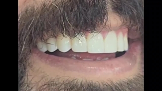 نمونه کار واقعی کامپوزیت دندان در لاهیجان