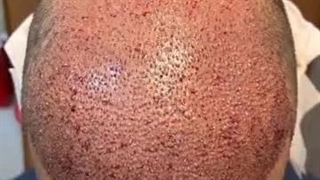 کاشت مو نازنین عسکری در شیراز