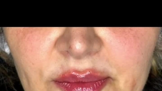 قبل و بعد از تزریق 0.8 سی‌سی فیلر لب از برند فرانسوی سیتوسیال