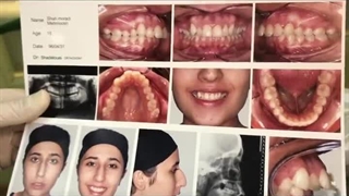 درمان عقب و جلو بودن فک ها