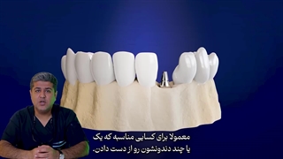 ایمپلنت یا لمینت؟ کدوم برای شما بهتره؟