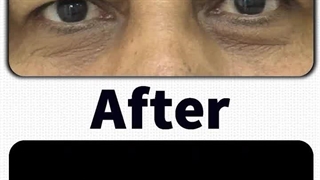 قبل و بعد از بلفاروپلاستی زیباجوی عزیز در کلینیک آفرینش