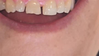 کامپوزیت دندان برای دندان‌های نامرتب؛ جایگزین ارتودنسی؟