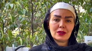 کاشت ابرو با موی سفید