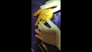 جراحی کف دست بیماری دوپویترن