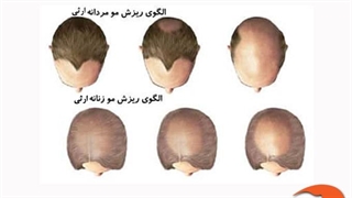 درمان ریزش مو مردان و زنان