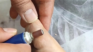 آموزش سنباده زدن پینه با کراتوریموال (متمم زخم)