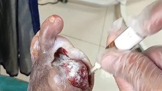 آموزش نحوه استفاده از پودر کلاژن ( متمم_زخم)