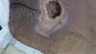 بررسی زخم بستر (متمم_زخم)