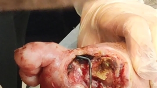 آموزش کوتر زخم (متمم_زخم)2