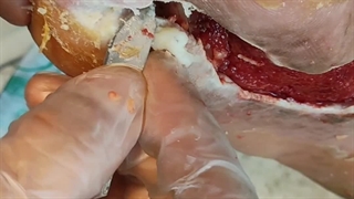 آموزش نحوه تمیز گردن اطراف زخم (متمم_زخم)