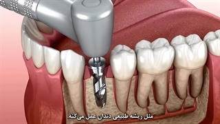 ایمپلنت دندان چیست؟ همه چیز درباره کاشت ایمپلنت دندان