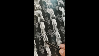 تشخیص کیست گانگلیون مچ دست