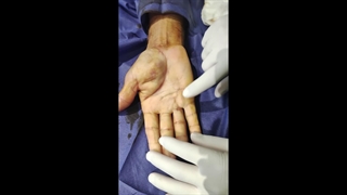 جراحی توده کف دست