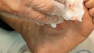 آموزش نحوه تراشیدن کالوس زخم (متمم_زخم) 2