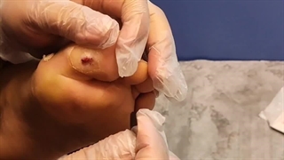 آموزش نحوه تراشیدن کالوس زخم (متمم_زخم) 4