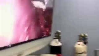 کله‌ سیستیت حاد صفرا چیست؟