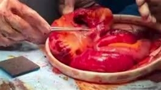 درمان خونریزی گوارشی با جراحی (قسمت دوم)