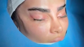 لیفت ابرو و شقیقه در تهران