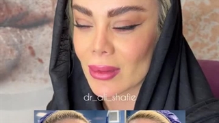 لیفت ابرو و شقیقه به شکل طبیعی در تهران