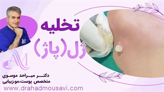 تخلیه ژل (پاژ): چه زمانی لازم است و چه انتظاری باید داشت