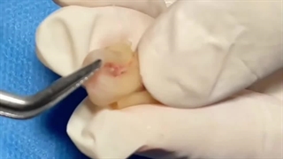 جراحی دندان عقل با موفقیت کامل