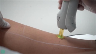 لیزر فول بادی شامل چه قسمت‌هایی می‌شود؟