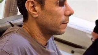 شش ماه پس از جراحی بینی