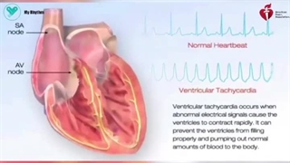 تاکی‌کاردی بطنی (Ventricular Tachycardia - V-tach)
