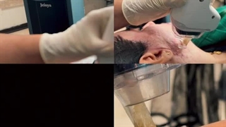 لیزر CO2 فرکشنال در فردیس