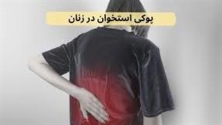 چرا پوکی استخوان در خانم‌ها شایع‌تر است؟