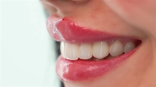 تجربه تزریق فیلر لب توسط مدیر سالن زیبایی بارانا در آرمو کلینیک | نتیجه طبیعی و بدون درد