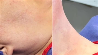 زاویه سازی و ساکشن غبغب